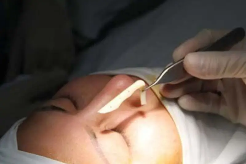 Phẫu thuật chỉnh sửa kịp thời giúp bảo tồn mô da và tránh hoại tử đầu mũi