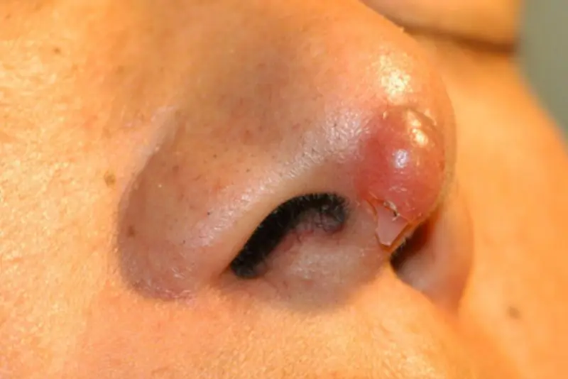 Đầu mũi mỏng, lộ sóng sụn rõ rệt là dấu hiệu cảnh báo tụt sụn