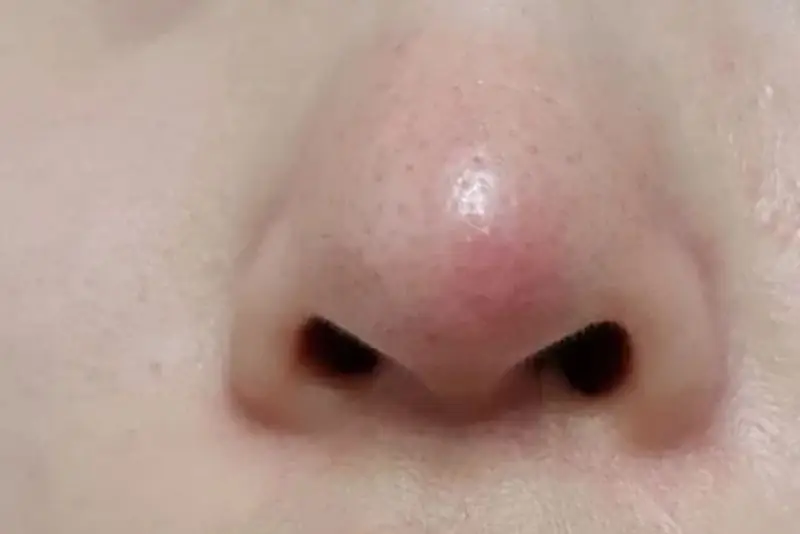 Vùng mũi sưng tấy kéo dài sau nâng cũng là nguy cơ phản ứng đào thải