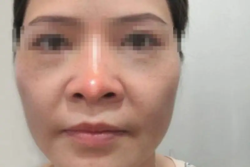 Tăng sinh mạch máu nuôi da đầu mũi là nguyên nhân gây đỏ kéo dài