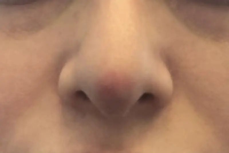 Đầu mũi đỏ nhẹ sau nâng mũi có thể là phản ứng hồi phục bình thường của cơ thể