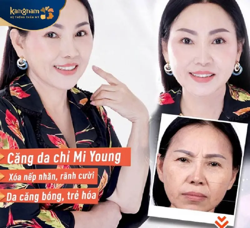 Căng chỉ Mi Young giúp xóa các nếp nhắn, giúp làn da căng bóng, mịn màng hơn
