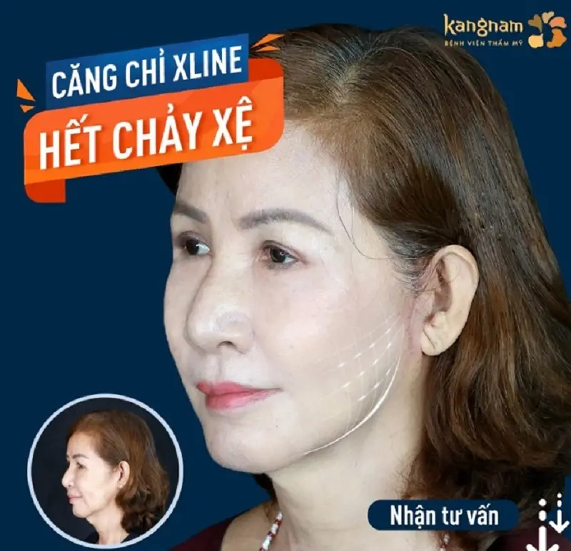 Căng chỉ Xline khắc phục làn da chảy xệ