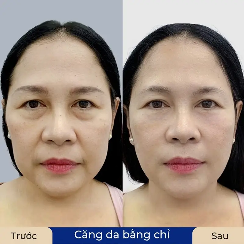 Căng da bằng chỉ giúp kích thích sản sinh collagen