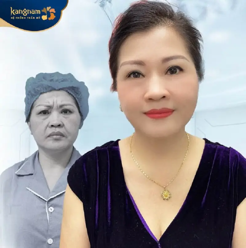 Phẫu thuật căng da mặt giúp khắc phục làn da chảy xệ