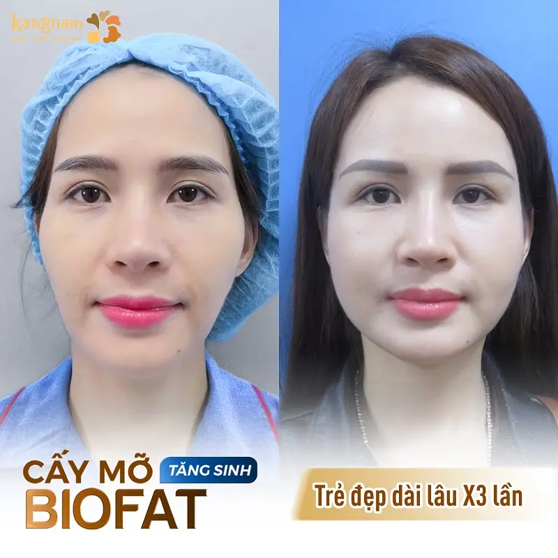Ứng dụng công nghệ cấy mỡ tiên tiến