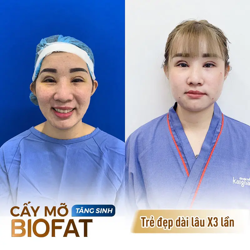 Khách hàng cấy mỡ tại Viện thẩm mỹ Kangnam Cần Thơ sở hữu khuôn mặt tươi trẻ, đầy đặn