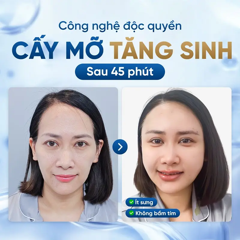 Bệnh viện Thẩm mỹ Kangnam đang ứng dụng công nghệ cấy mỡ tăng sinh, mang lại hiệu quả cao