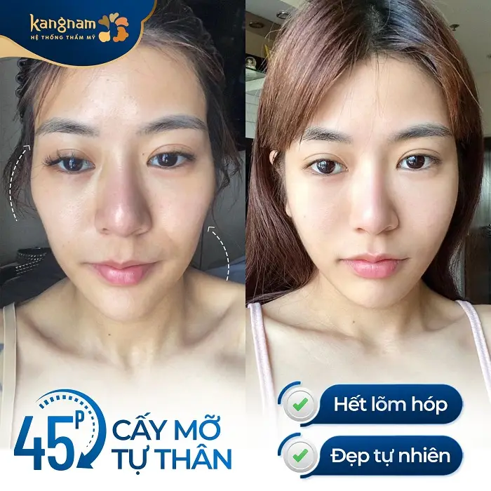 Rút ngắn thời gian phục hồi và hiệu quả thẩm mỹ duy trì lâu dài