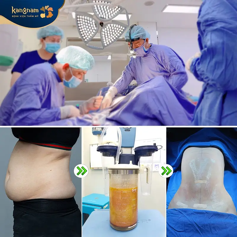 Ứng dụng công nghệ hút mỡ hiện đại, do bác sĩ chuyên khoa nhiều năm kinh nghiệm thực hiện