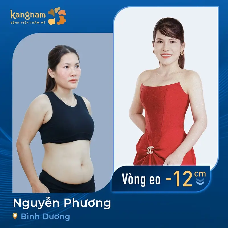 Khách hàng tại Bình Dương sau khi hút mỡ đã sở hữu vóc dáng thon gọn, cân đối