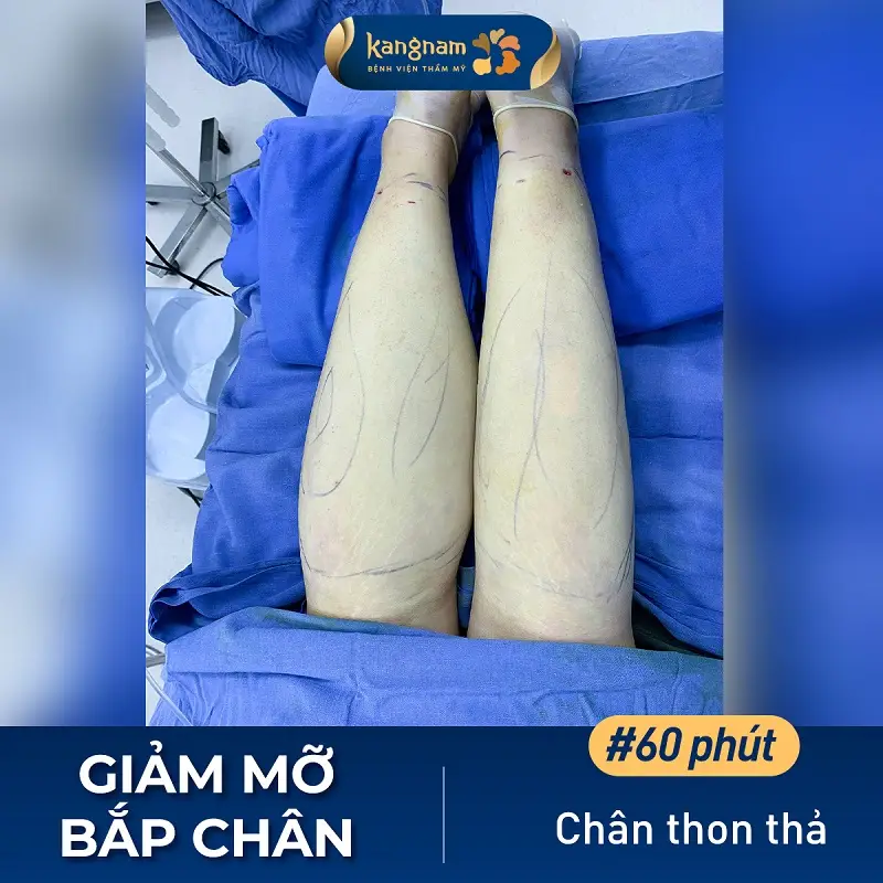 Phương pháp hút mỡ có thể thực hiện ở đa dạng các vùng