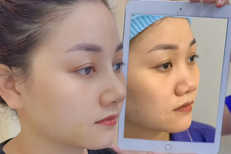 Viện Thẩm Mỹ Kangnam Nghệ An có dịch vụ nâng mũi đạt chuẩn