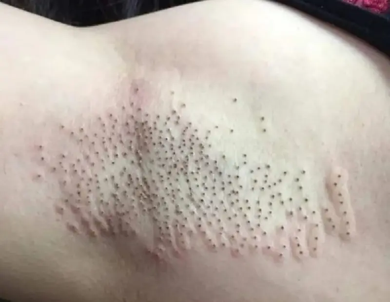 Đốt điện trị hôi nách có thể không loại bỏ hoàn toàn tình trạng mùi hôi khó chịu