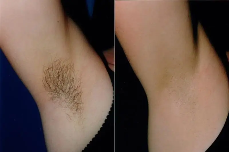 Triệt lông nách hạn chế ma sát, giúp da mịn hơn