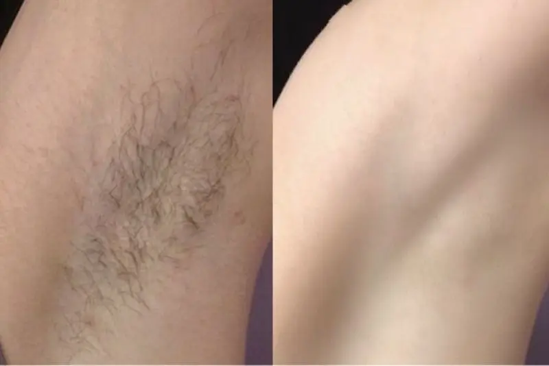 Triệt lông nách giúp vùng da dưới cánh tay thông thoáng