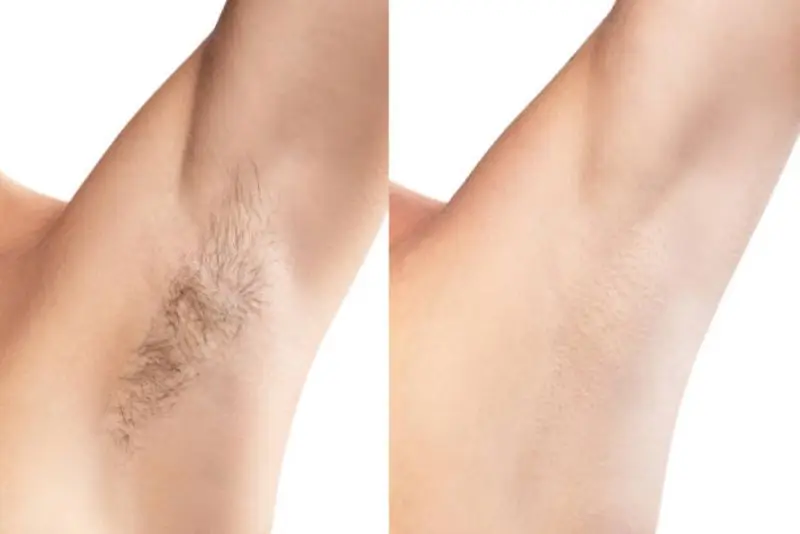 da có thể sáng mịn hơn sau khi triệt lông nách