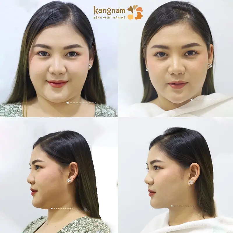 Khách hàng sở hữu khuôn mặt thon gọn sau khi hút mỡ mặt