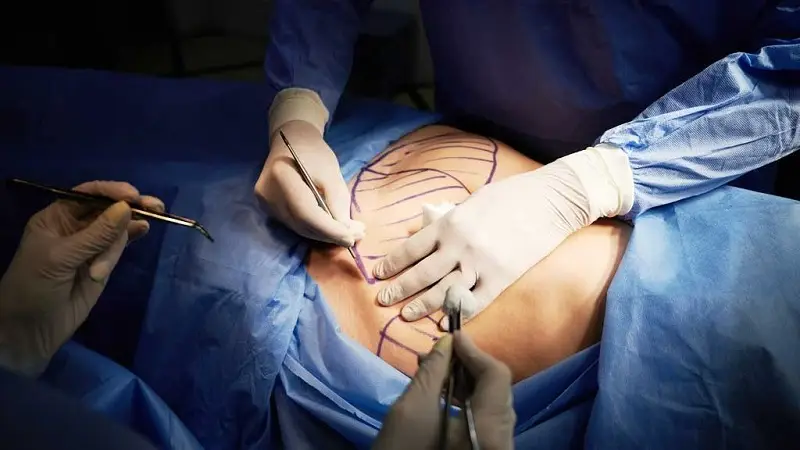 Bệnh viện Chợ Rẫy hiện áp dụng hai phương pháp hút mỡ