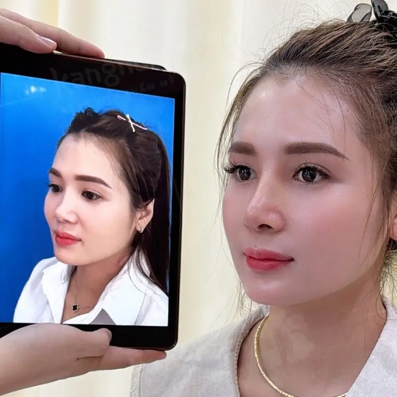 Nâng mũi kết hợp sụn tai tạo độ mềm mại cho dáng mũi