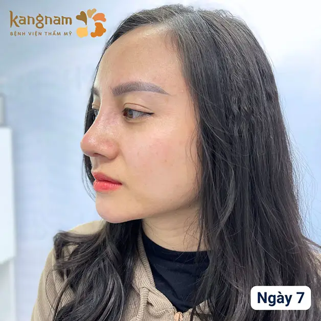 Mũi thẳng, đầu mũi mềm mại, không còn dấu hiệu sưng viêm.