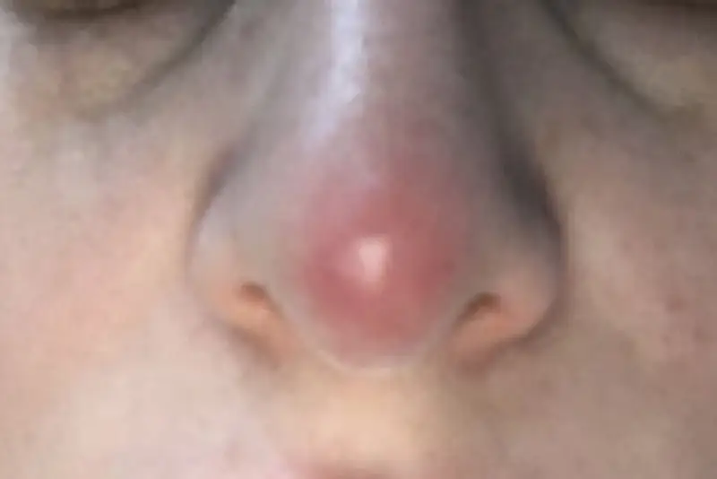 Mũi bóng đỏ, lộ sống khi nâng mũi quá cao