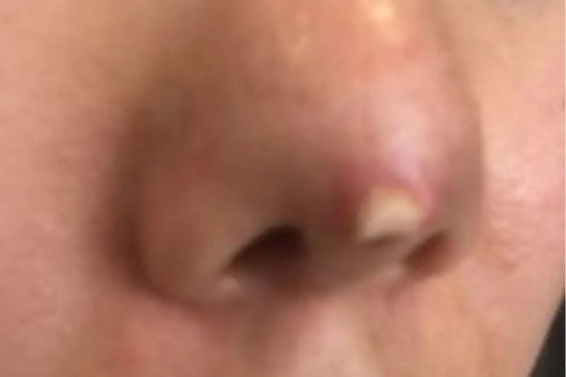 Hình ảnh mô phỏng sụn nhân tạo bị đẩy lộ ra ngoài da