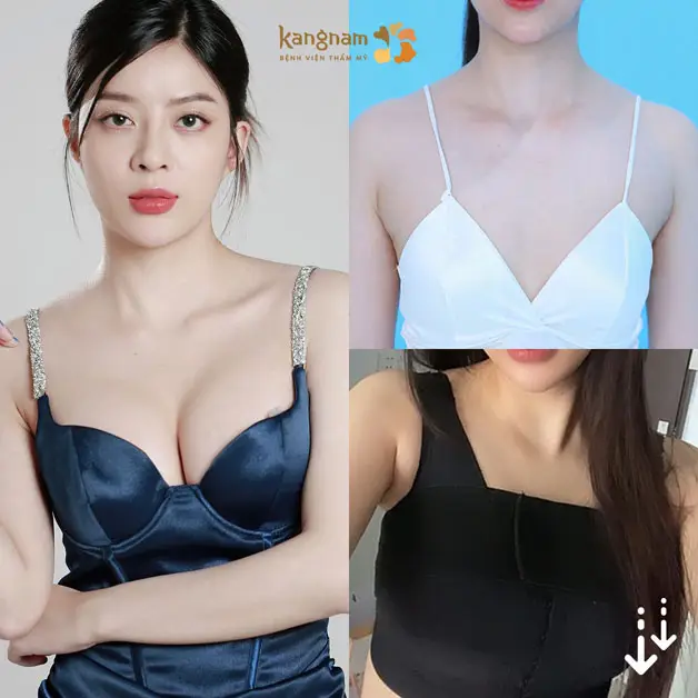 Khách hàng sau nâng ngực tại Kangnam