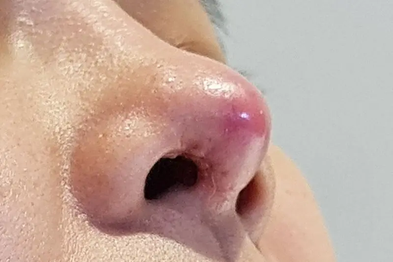 Vùng đầu mũi đỏ kèm theo sưng tấy là dấu hiệu nhiễm trùng