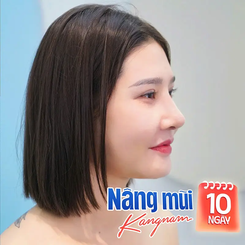 Kết quả sau 10 ngày phẫu thuật: đầu mũi đã ổn định, form mũi đẹp tự nhiên không lộ dấu vết can thiệp