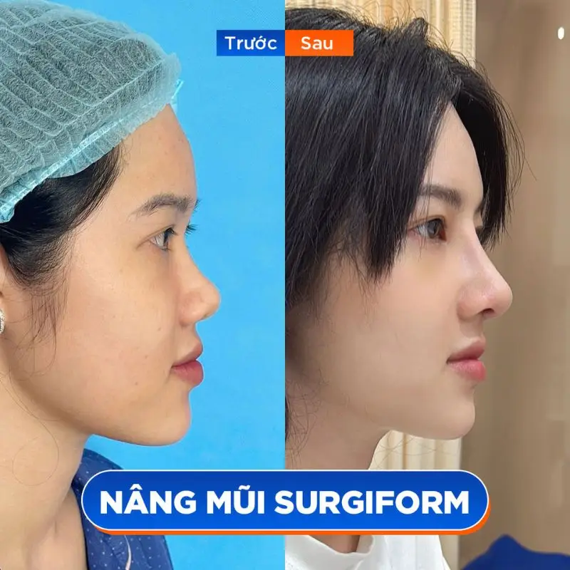 So sánh trước và sau nâng mũi dựng trụ: mũi cao thẳng, đầu mũi mềm mại