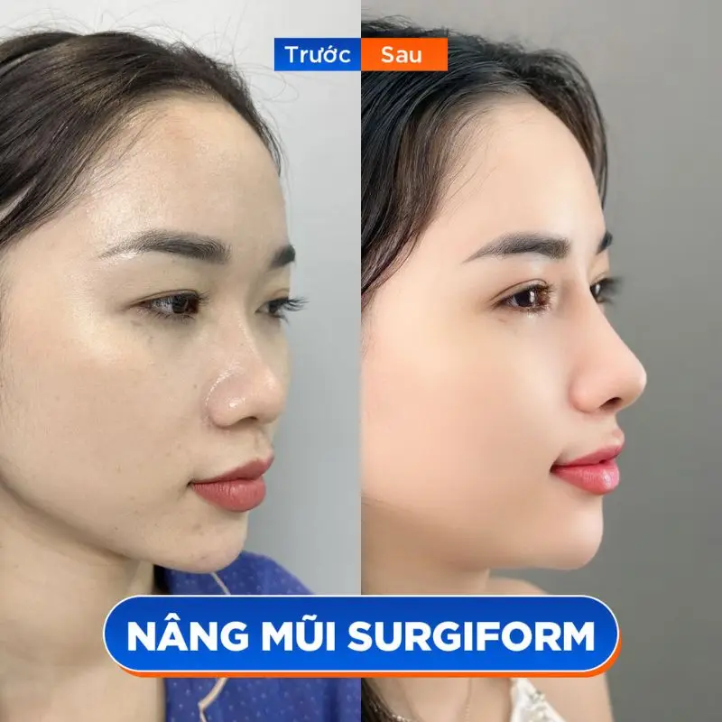 Dáng mũi đẹp tự nhiên sau phẫu thuật