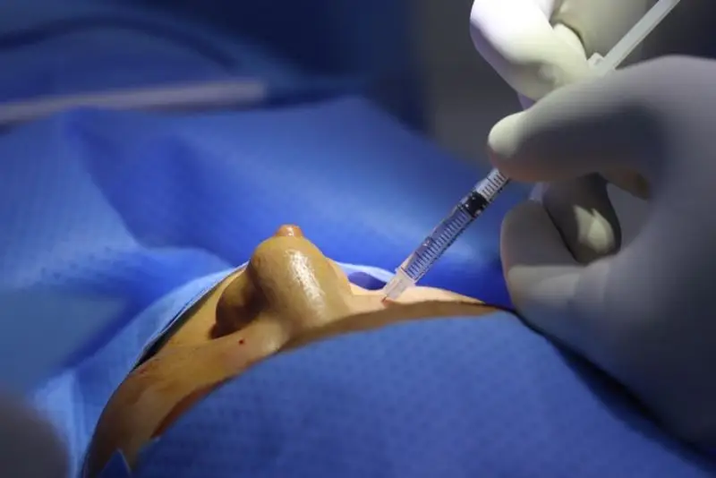 Quá trình nâng mũi bằng trung bì mỡ