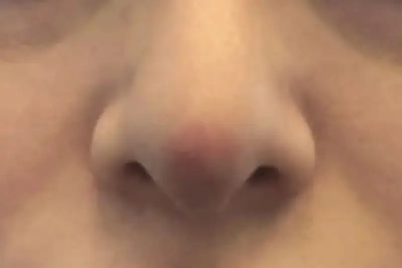 Mũi sưng tấy bất thường cần thăm khám ngay