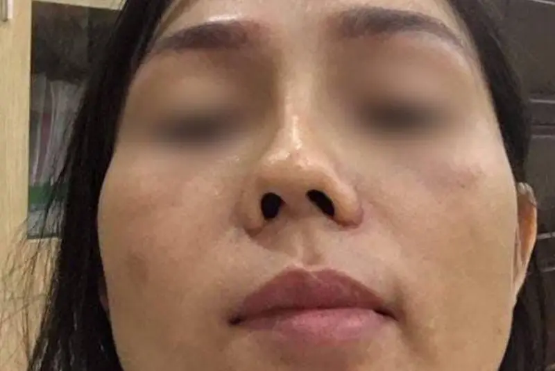 Mũi nghiêng vẹo hẳn sang một bên