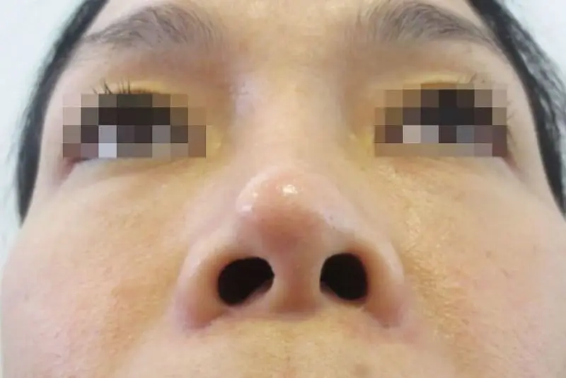 Mũi bị lệch có dấu hiệu: hai bên cánh mũi không đều, đau nhức kéo dài hoặc khó chịu