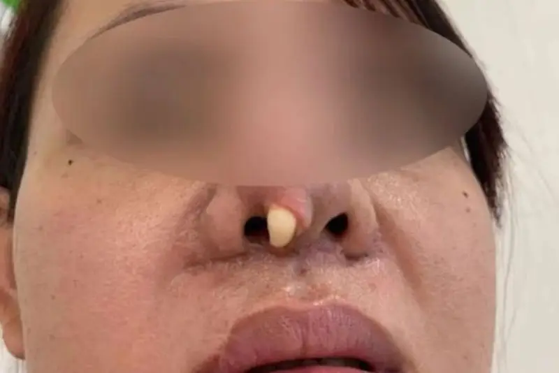 Trường hợp sụn đã trồi hẳn ra ngoài da