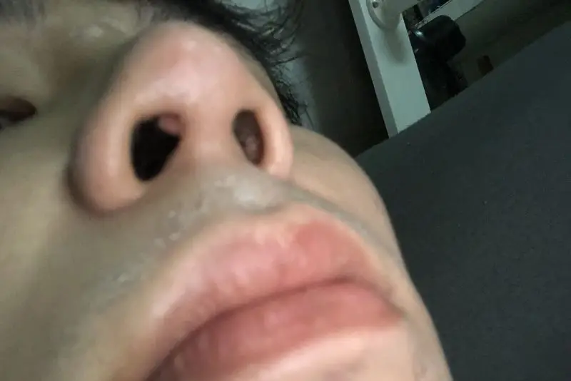 Nâng mũi bị lòi sụn là sụn cấy ghép vào mũi bị lòi ra khỏi vị trí ban đầu