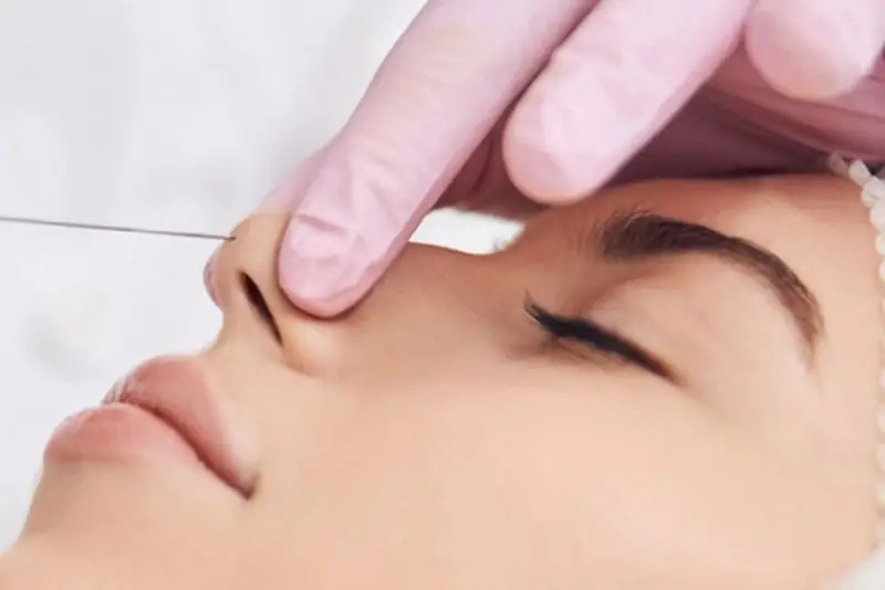 Căng chỉ mũi là phương pháp không phẫu thuật