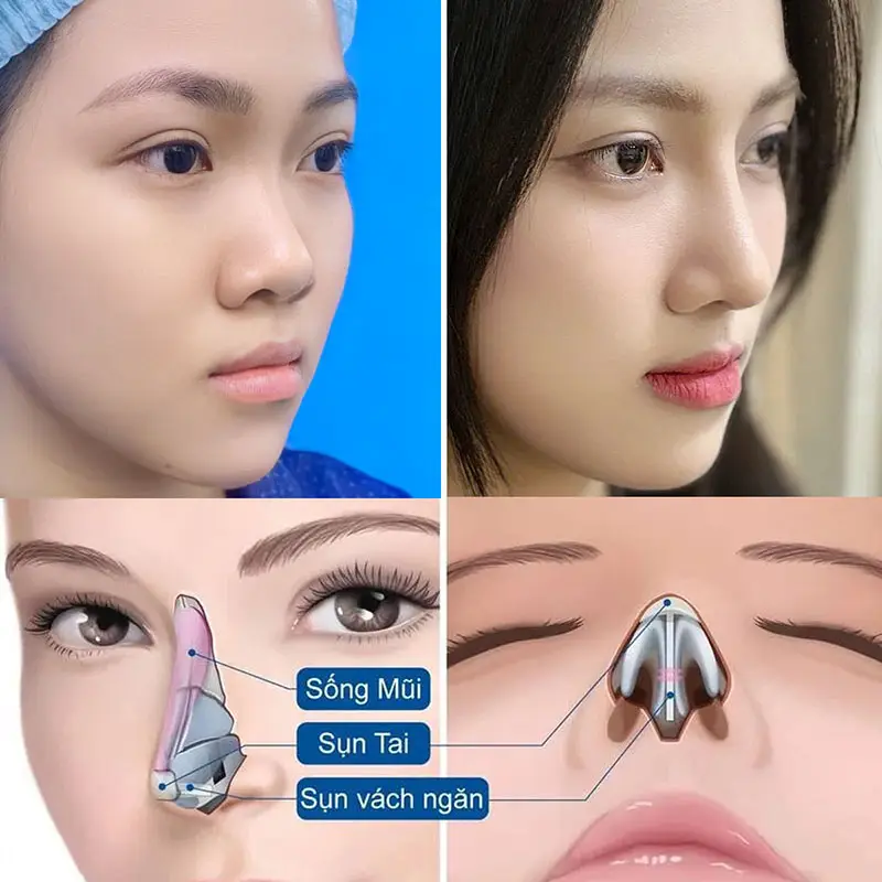 Nâng mũi vi phẫu thường được áp dụng trong nâng mũi cấu trúc,
