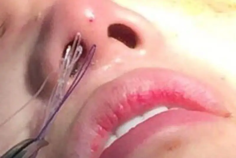 Biến chứng do nâng mũi chỉ sai kỹ thuật