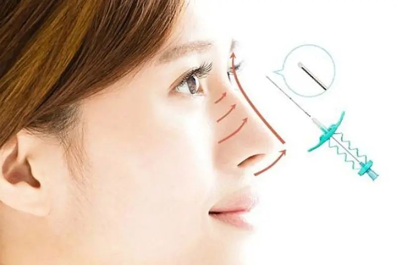 Nâng mũi chỉ Hiko được đánh giá là an toàn