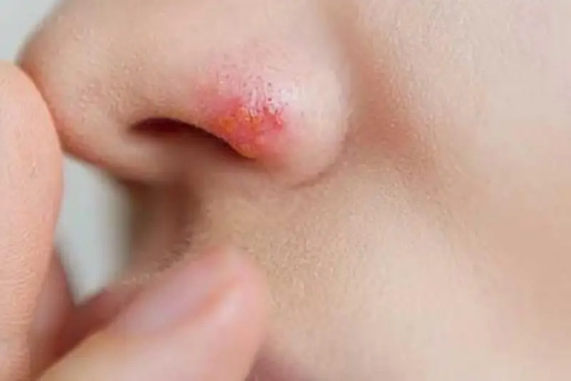 Nặn mụn sau nâng mũi tăng nguy cơ để lại sẹo