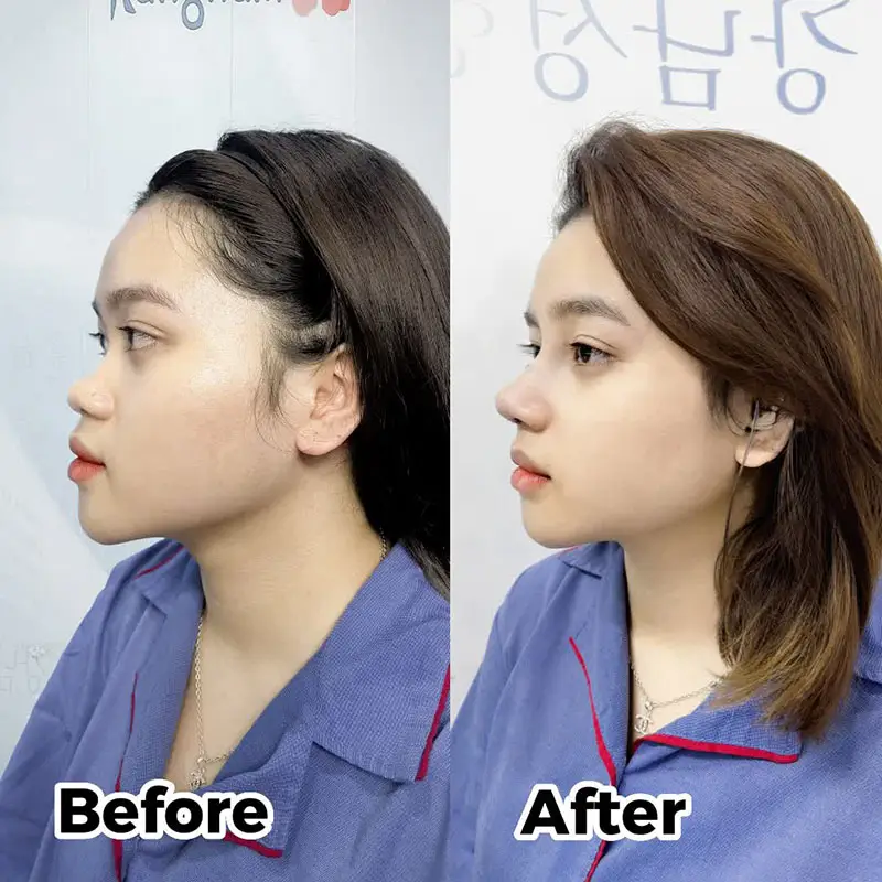 Sống mũi cao bay, hài hòa với đường nét gương mặt