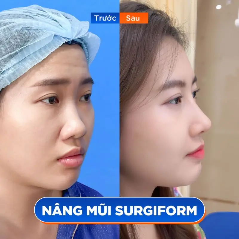 Dáng mũi cao bay tự nhiên