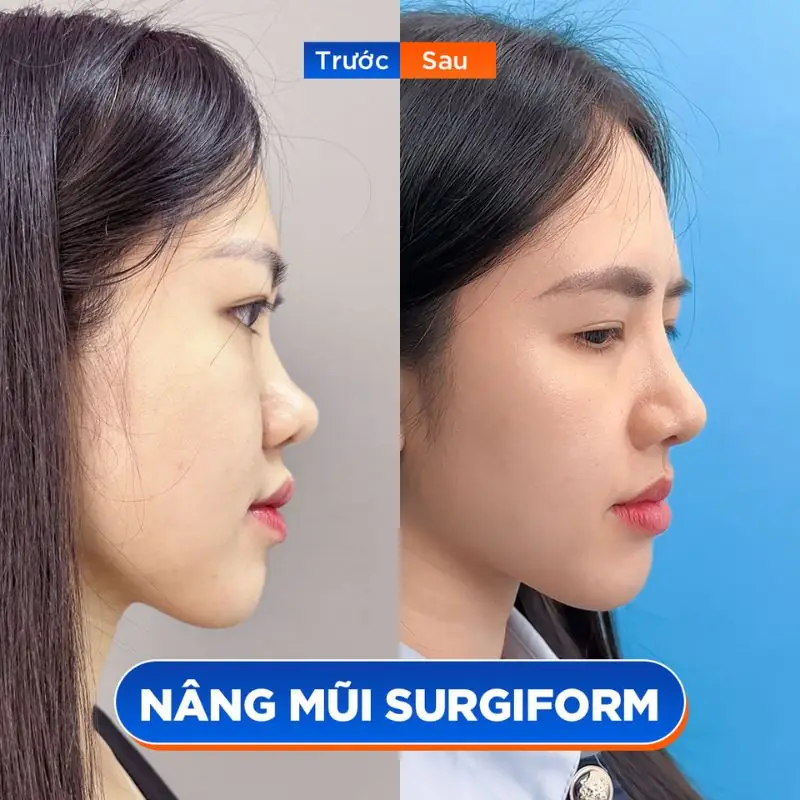 Khách hàng với sống mũi tẹt, sau nâng mũi cấu trúc thanh thoát rõ rệt