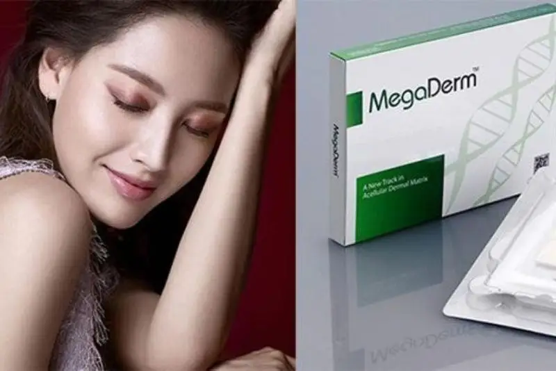 Nâng mũi Megaderm là phương pháp sử dụng sụn Megaderm nâng mũi
