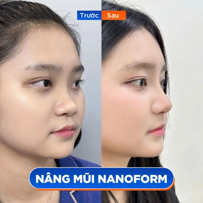 Dáng mũi Sline nhẹ nhàng cho khuôn mặt tròn