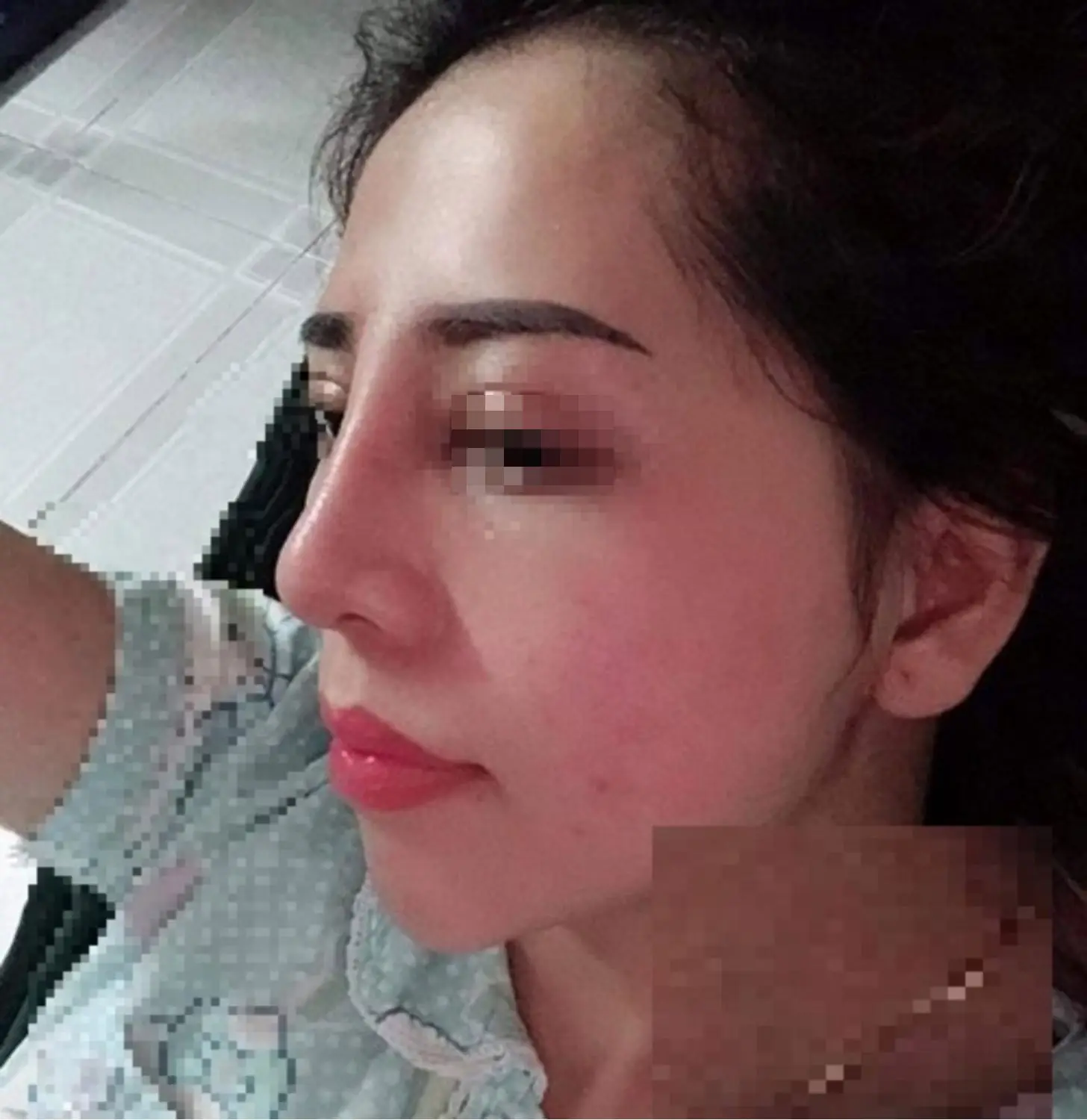 Nâng mũi quá cao có thể làm tổn thương mô mềm