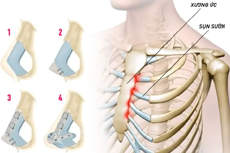 Mô phỏng quy trình tái cấu trúc toàn bộ dáng mũi bằng sụn sườn tự thân